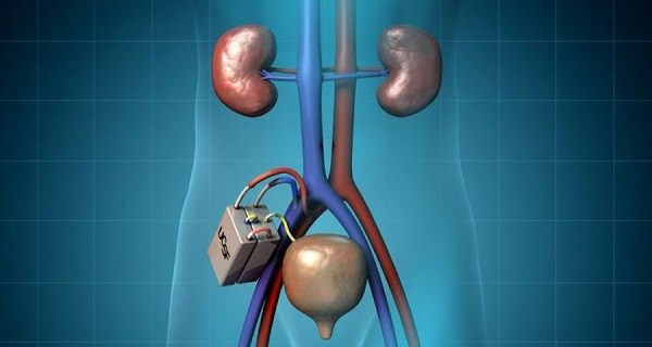 The bionic kidney will reduce several complications